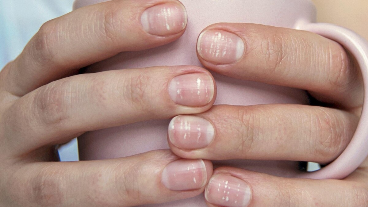 Белые пятна на ногтях появляются по двум причинам: дерматолог расставила точки над «и»