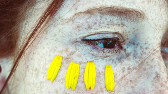 Опасны ли веснушки для здоровья: что говорят врачи