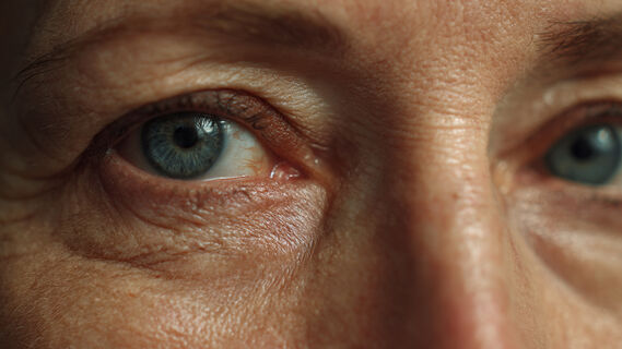 Мешки под глазами