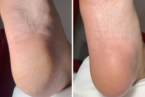 Как убрать трещины на "наждачных" пятках дома: бархатные стопы без салона — кожа нежнее, чем у младенца